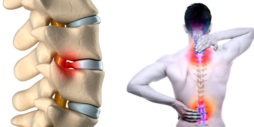ГРЫЖА ПОЗВОНОЧНИКА : ОПАСНОЕ И НЕПРИЯТНОЕ ЗАБОЛЕВАНИЕ