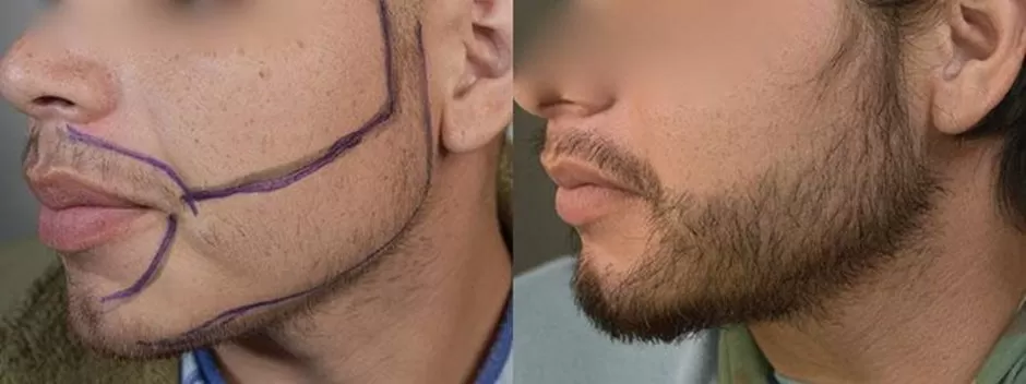 Все о пересадке бороды - преимущества и этапы процедуры без секретов
